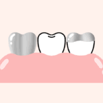 詰め物・被せ物